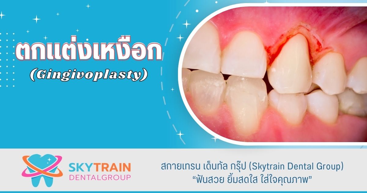 บริการ] ผ่าตัดเหงือก ตกแต่งเหงือกเพื่อความสวยงาม - Skytrain Dental